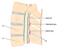 Catheter in epidural space