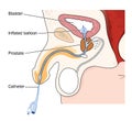 Catheter placed in male bladder