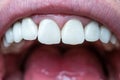 Caucasian male open mouth showing row of white teeth and back of the throat. Close up macro shot, unrecognizable face Royalty Free Stock Photo