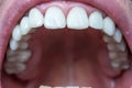 Caucasian male open mouth showing row of white teeth and back of the throat. Close up macro shot, unrecognizable face Royalty Free Stock Photo