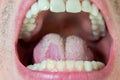 Caucasian male tongue with yeast infection candida. Macro close up shot, unrecognizable