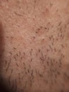 caucasian skin with ingrown hair and man short beard Royalty Free Stock Photo