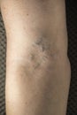 Caucasian woman have a varicose on inner side of arm