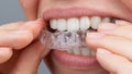 Caucasian woman putting on aligners. Orthodontic teeth straightening device.