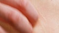 Caucasian woman strongly combs reddened skin with nail marks close-up. Skin problems, eczema, giardia