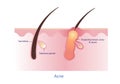 Cause of acne vector. Royalty Free Stock Photo