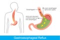 Cause of gastroesophageal reflux disease in human stomach Royalty Free Stock Photo