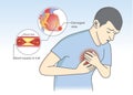 Cause of heart attack symptoms from blood flow get blocked.