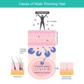 Cause of Male Thinning Hair. Illustration