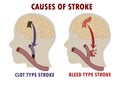 Cause of stroke: comparison of hemorrhagic and ischemic stroke