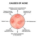 Causes of acne. Pustules, papules, comedones, blackheads, acne on the skin. Infographics. Vector illustration on Royalty Free Stock Photo