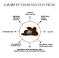 Causes of clear mucus in the feces. Diseases of the gastrointestinal tract. Infographics. Vector illustration on