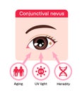 Causes of Conjunctival nevus vector illustration