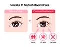 Causes of Conjunctival nevus vector illustration