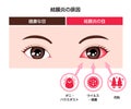 Causes of conjunctivitis pink eye vector illustration