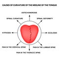 Causes of curvature of the midline of the tongue. Definition of a disease according to human tongue. Diagnostics by Royalty Free Stock Photo