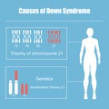Causes of Down Syndrome Royalty Free Stock Photo