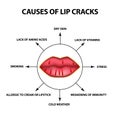 Causes of lip cracks. Cracks in the corners of the mouth. Infographics. Vector illustration on isolated background.