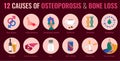 Osteoporosis Infographic Poster