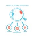 Causes of retinal hemorrhage. Vector illustration Royalty Free Stock Photo