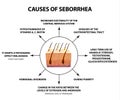 Causes of seborrhea. Seborrhea skin and hair. Dandruff, seborrheic dermatitis. Baldness, hair growth, baldness Royalty Free Stock Photo