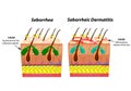 Causes Seborrhea skin and hair. Dandruff seborrheic dermatitis. Eczema. Dysfunction of the sebaceous glands