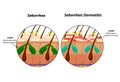 Causes Seborrhea skin and hair. Dandruff seborrheic dermatitis. Eczema. Dysfunction of the sebaceous glands