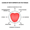 Causes of Teeth Imprints on the Tongue. Definition of a disease according to human tongue. Diagnostics by tongue. Tongue Royalty Free Stock Photo