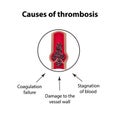 Causes of thrombocytosis. Embolism. Infographics. Vector illustration on isolated background