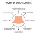 Causes of umbilical hernia. Infographics. Vector illustration on isolated background.
