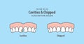 Cavities & Chipped illustration vector on blue background.