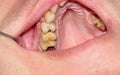 Cavities and old fillings in the upper teeth Royalty Free Stock Photo