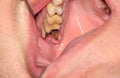 Cavities and old fillings in the upper teeth