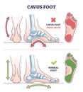 Cavus foot with abnormal high arch condition to feet bones outline diagram Royalty Free Stock Photo