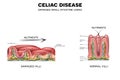 Celiac disease Royalty Free Stock Photo