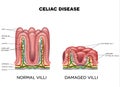 Celiac disease Royalty Free Stock Photo