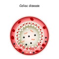 Celiac disease. Cross section of Small intestine Royalty Free Stock Photo