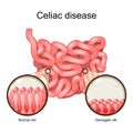 Celiac disease. cross section of a small intestine