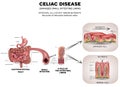 Celiac disease Royalty Free Stock Photo