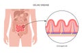 Celiac disease inflammation