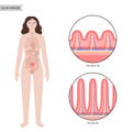 Celiac disease inflammation