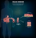 Celiac disease info poster