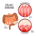 Celiac disease. small intestinal with normal villi, and villous Royalty Free Stock Photo