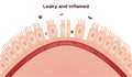 Celiac disease Small intestine lining damage. good and damaged villi . leaky gut progression Royalty Free Stock Photo