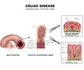 Celiac disease Small intestine lining damage Royalty Free Stock Photo