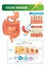 Celiac disease vector illustration. Labeled diagram with its structure Royalty Free Stock Photo