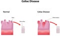 Celiac Disease