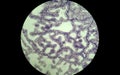 Glandular epithelium. Green gland cancer preparation.