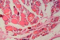 Human thyroid gland with goiter caused by deficiency of iodine under a microscope