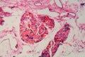 Human thyroid gland with goiter caused by deficiency of iodine under a microscope